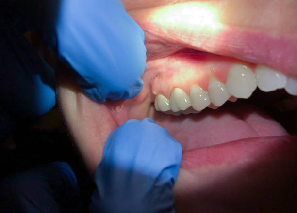 Best Dentist for Tooth Abscess  in Pittsville, MD